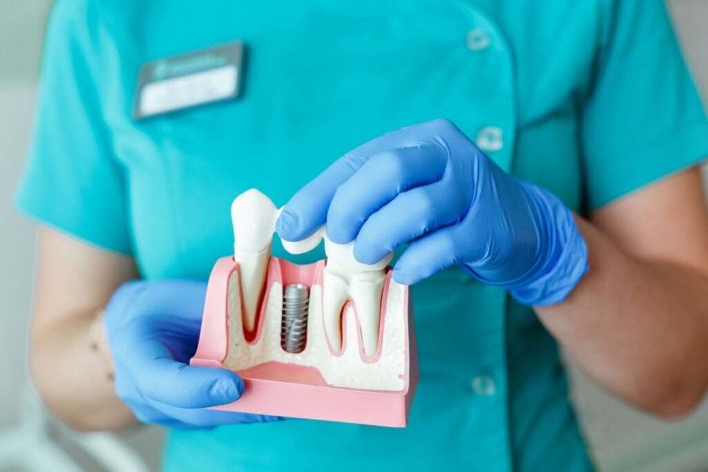 The Dental Edition | Dental Implants