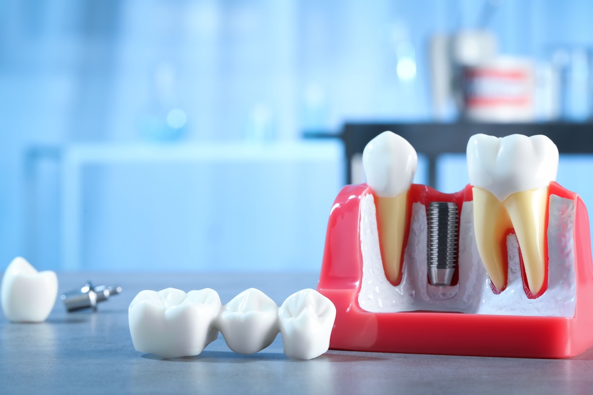 The Dental Edition | Dental Implants